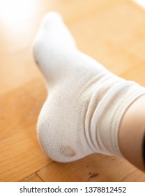 Sock With Blood Stain From Blister On The Heel.