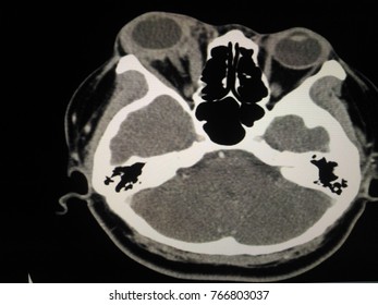 Soft And Blur CT Scan Orbits : Impression Enlargement Of Extra Occular Muscle And Intra Conal Inflammatory Mass Cause Exophthalmos Of Rt.orbits