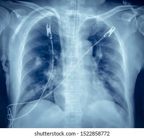 Soft And Blurry Image, A Chest Xray Film Of A Patient Showing Of Endotracheal Intubation, Central Venous Catheter And ECG (Electrocardiogram)