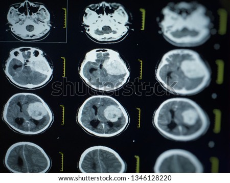 Soft and blurry image computed tomography or CT images of brain collection finding mass or tumor in side the brain.