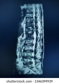 Lumbar Spine Xray Showing Isthmic Spondylolisthesis: Stockfoto (Jetzt ...