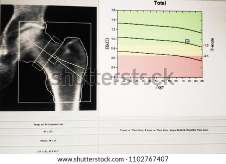 Soft And Blurry Image Special Examination Medical Image Hip Bone Density Soft And Blurry Image Special Examination Medical Image Hip Bone Density