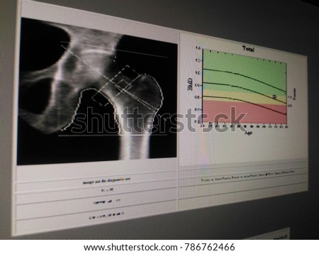 Soft And Blurry Image Special Examination Medical Image Hip Bone Density Soft And Blurry Image Special Examination Medical Image Hip Bone Density