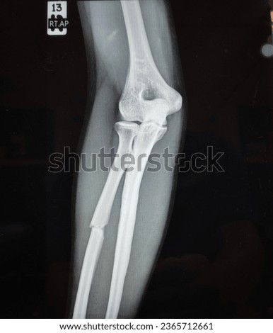 Soft and blurry image x-ray forearm with elbow fracture ulna bone Medical image concept.