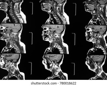 Soft Blurry Imagemri Brain Oropharynx Mass: foto stock (editar agora ...