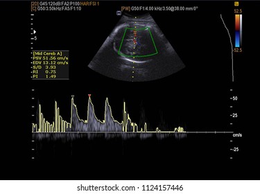 Soft And Blurry Medical Image,Ultrasound  Abdomen A Female 35 Year Old.