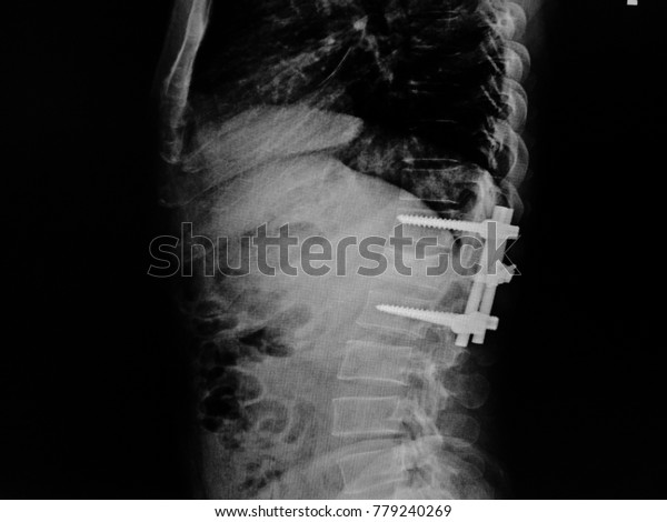 Soft Blurry Xray Tl Spinethoracospinepost Fixed Stock Photo Edit Now