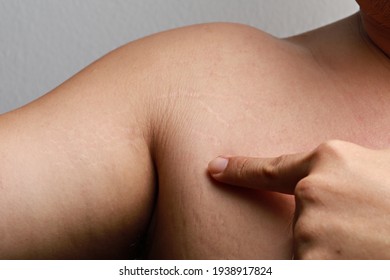 Soft focus image of body striae, stretch marks on the adult arm.