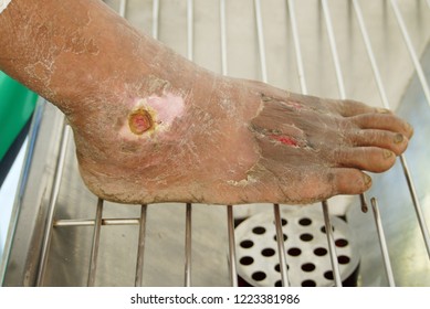 Soft Focus At  Infection Wound  On Foot From Diabetic Ulcer In The Emergency Room  Use For Health Care And Medical Background.