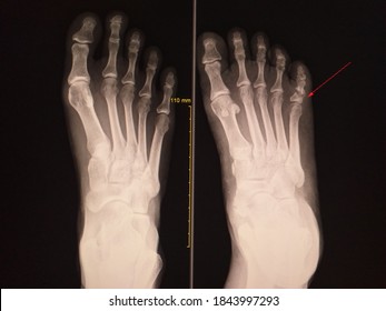 Soft And Out Of Focus X-ray Foot AP 2 Views Showing Normal And Fracture Proximal Phalanges 5th,Medical Healthcare Concept.