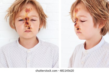 Soft Tissue Contusion, Extensive Edema Of Young Boy Face, As A Result Of A Fall From A Bicycle