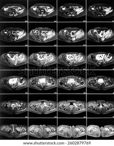 Soft tissue mass around the left iliac bone of underlying bone with neoplastic Infiltration to regional muscle; possiblities are Secondary Metastasis,myeloma, osteosarcoma,chondrosarcoma,chordoma.