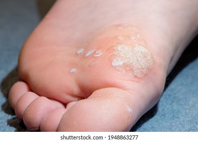 Sole of foot showing salicylic acid treatment of mosaic plantar wart and other verrucas