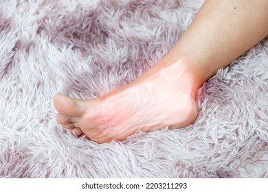 Soles Inflammation Of The Human Foot Bones