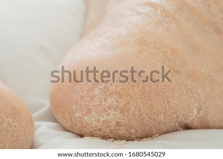 soles of the skin 
Age of skin and illness