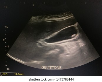 Sonography Of Abdomen Shows A Gallstone In Gallbladder.