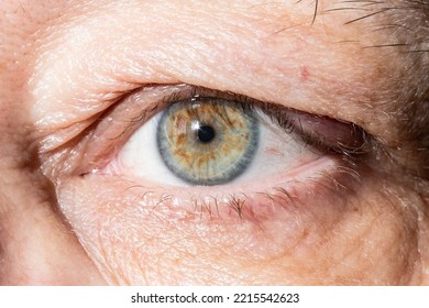 Sore Eye With Thickening On Eyelid From Chalazion Close Up