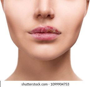 problem hiv in mouth Herpes Images, & Vectors Stock Photos Shutterstock