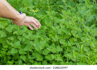 Sore Hand From Touching Nettles Or Stinging Nettles Health Concept