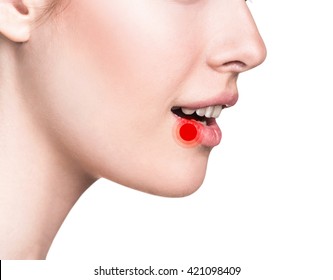 Sore on the female lips - Shutterstock ID 421098409