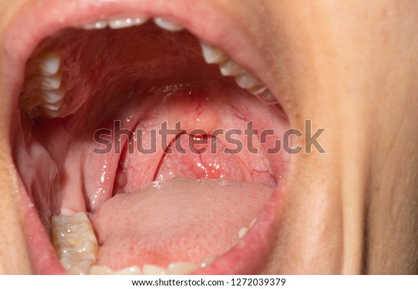 sore-throat-advanced-ear-nose-throat