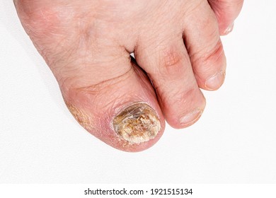 painful toenail