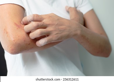 Sores from scratching allergy to arm women.