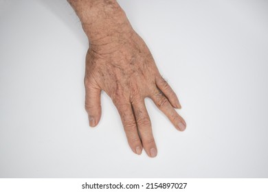 Spastic Hand. Hand Muscle Spasticity. Concept Of Hand Health.