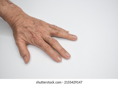 Spastic Hand. Hand Muscle Spasticity. Concept Of Hand Health. Isolated On White.