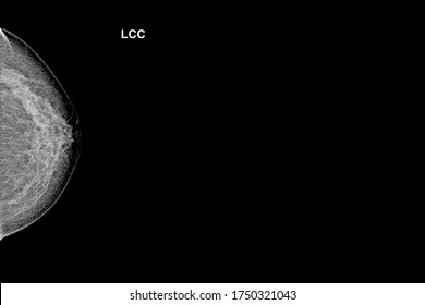 Special Mammogram Image (Craniocaudal View - CC)Examination In Women Over The Age Of 35 Year Old -Left Breast.Medical Checkup Image Concept.