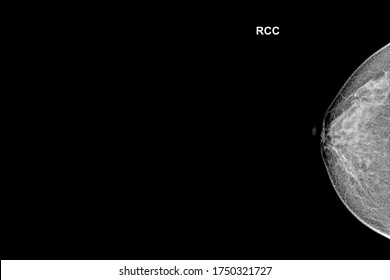 Special Mammogram Image (Craniocaudal View - CC)Examination In Women Over The Age Of 35 Year Old -Right Breast.Medical Checkup Image Concept.