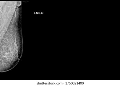 Special Mammogram Image (Mediolateral Oblique - MLO)Examination In Women Over The Age Of 35 Year Old -Left Breast.Medical Checkup Image Concept.