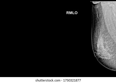 Special Mammogram Image (Mediolateral Oblique - MLO)Examination In Women Over The Age Of 35 Year Old -Right Breast.Medical Checkup Image Concept.