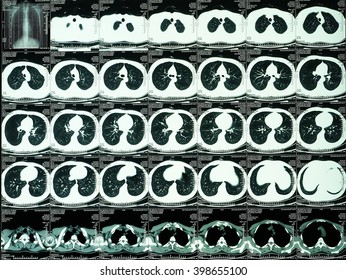 Special photography, chest CT scanning                               