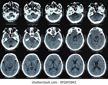 Special Photography, Head CT Scan Pictures