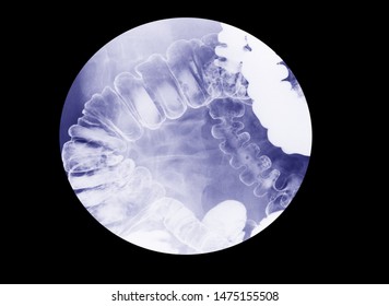 Special X-ray Examination Spot Film Barium Enema Examination  (lower Gastrointestinal (GI))