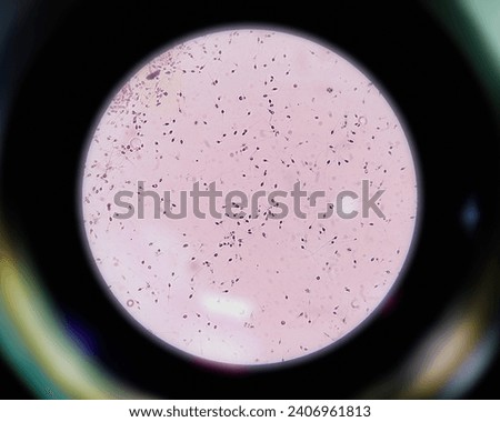 Sperm analysis on microscopic examination, Normozoospermia, normal semen analysis.