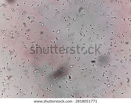 Sperm analysis on microscopic examination, Normozoospermia, normal semen analysis.
