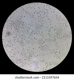 Sperm Morphology. Semen Photo Under Microscope. Micrograph Showing Spermatozoon's, Azoospermia Semen With Infection(pus Cell) Slide Focus