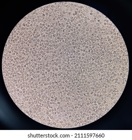 Sperm Morphology. Semen Photo Under Microscope. Micrograph Showing Spermatozoon's, Azoospermia Semen With Infection(pus Cell) Slide Focus