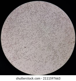 Sperm Morphology. Semen Photo Under Microscope. Micrograph Showing Spermatozoon's, Azoospermia Semen With Infection(pus Cell) Slide Focus