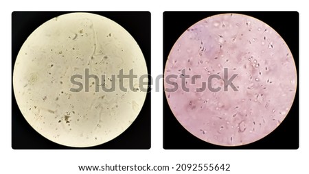 Sperm or semen test or analysis concept photo. Two collage of microphotography, one is showing Azoospermia with plenty pus cells another Normozoospermia