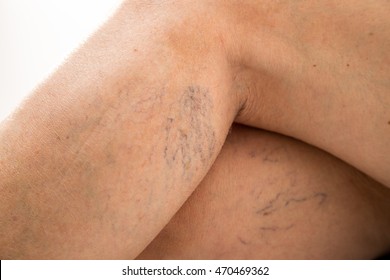 Spider Veins On Leg 