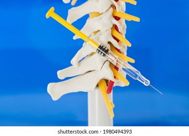 Spinal infiltration as pain therapy. Lateral view of model of cervical spine with cervical vertebrae, vertebral artery, cervical discs, spinous process, spinal nerves on blue background and syringe