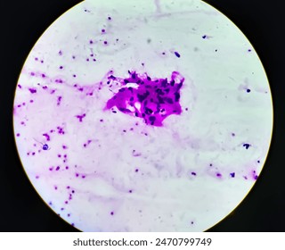 Spinal Intramedullary Tuberculosis analysed by light microscope of bone marrow aspiration cytology. Bone (TB) Mycobacterium Tuberculosis. Rare photomicrograph 