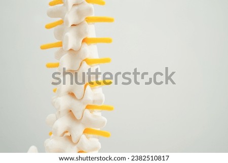 Spinal nerve and bone, Lumbar spine displaced herniated disc fragment, Model for treatment medical in the orthopedic department.