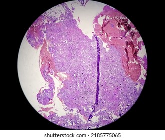 Spinal Tumor Biopsy: Psammomatous Meningioma. Psammoma Bodies.