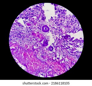 Spinal Tumor Biopsy: Psammomatous Meningioma. Psammoma Bodies.