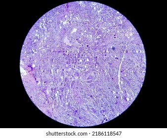 Spinal Tumor Biopsy: Psammomatous Meningioma. Psammoma Bodies.