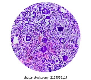 Spinal Tumor Biopsy Showing Psammomatous Meningioma. Psammoma Bodies.